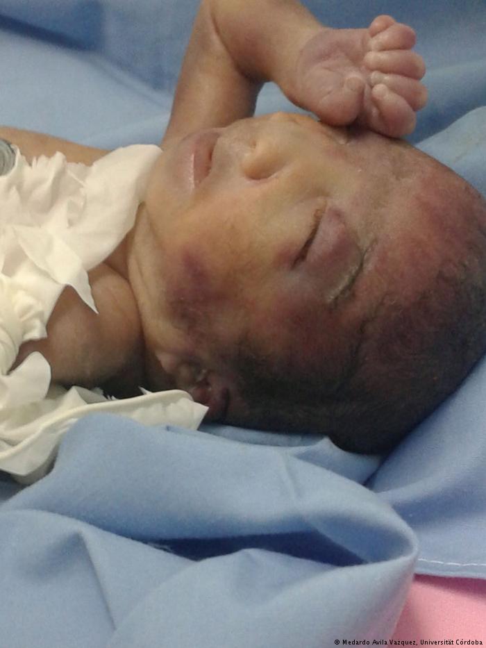 00 Argentina Malabrigo con síndrome de Edwards. Debido al daño genético la esperanza de vida es solo de unos pocos días