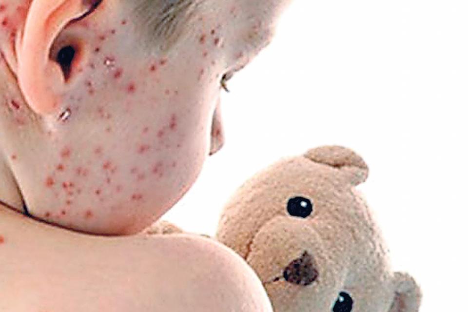 20 03 01 OP El coronavirus acecha el sarampión y el dengue ya nos atacaron 3 Los bebés no pueden vacunarse