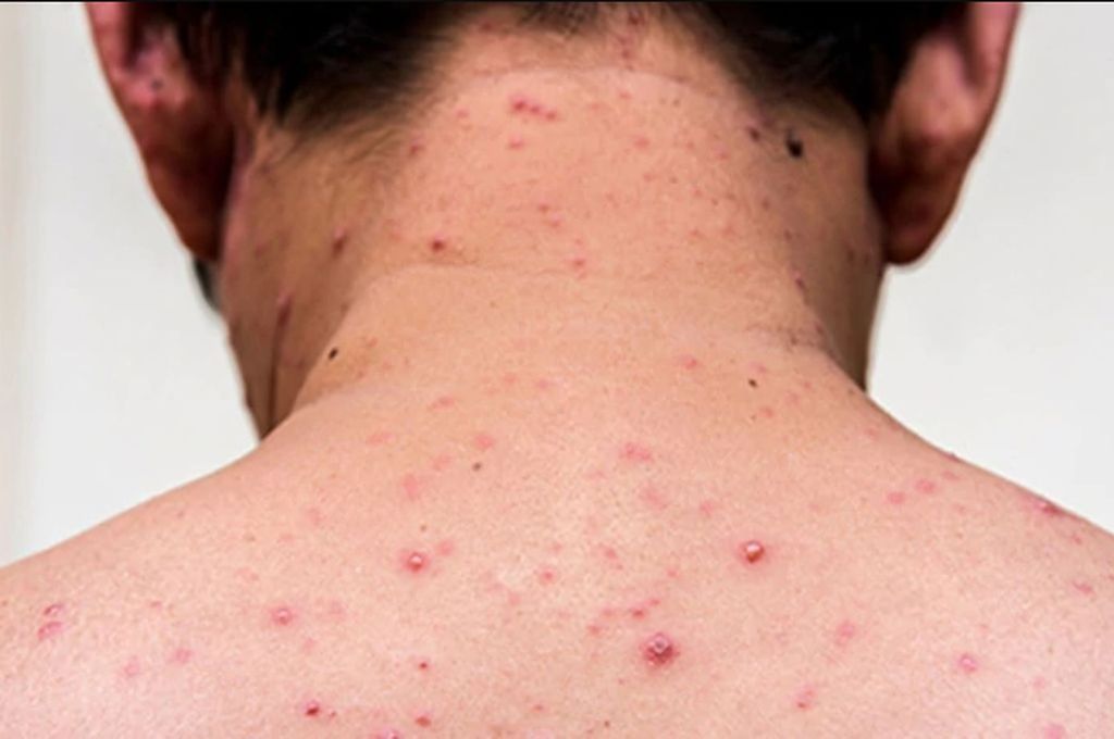 20 03 01 OP El coronavirus acecha el sarampión y el dengue ya nos atacaron 4 Paciente adulto con sarampión