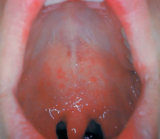 20 03 07 OP Sarampión síntomas y tratamiento 3 Manchas de Koplik en la mucosa oral de un paciente