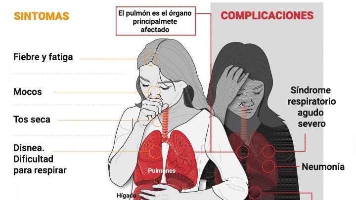 20 03 31 OP Fabrican respiradores de alta tecnología en Córdoba 3 Síntomas y complicaciones
