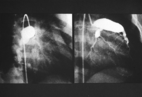 20 11 05 OP Coronavirus y el mal de Kawasaki en los niños 1 Aneurisma gigante de arterias coronarias