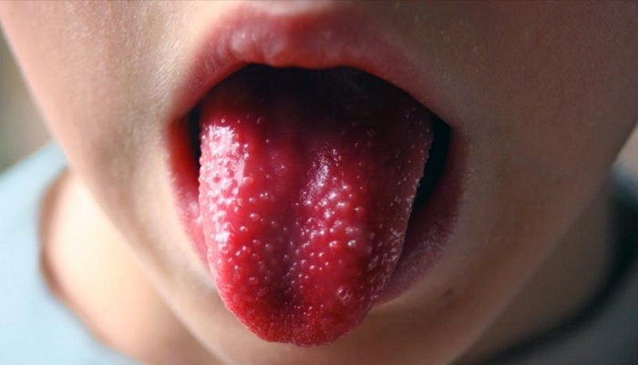 20 11 05 OP Coronavirus y el mal de Kawasaki en los niños 3 Sintoma de la Enfermedad de Kawasaki